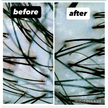 頭皮の汚れ_20251211_1